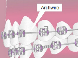 Archwires
