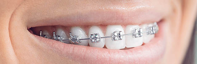 Metal Braces